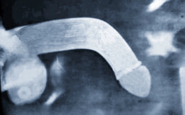 Κάταγμα Πέους