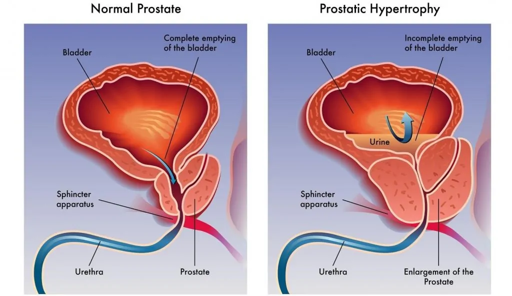 kaloithis-yperplasia-prostati