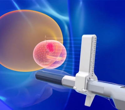 Μεγαλύτερη διαγνωστική ακρίβεια της διαπερινεϊκής στοχευμένης MRI fusion βιοψίας προστάτη έναντι της διορθικής μεθόδου