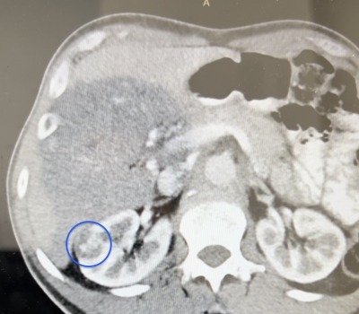 Χρήση της ρομποτικής τεχνολογίας των συστημάτων Da Vinci XI και Χ High Definition στην Ρομποτική Μερική Νεφρεκτομή