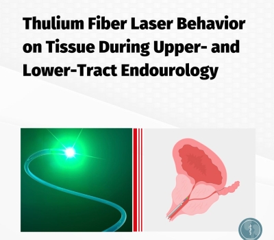 Οι επιδράσεις του νέου TFL λέιζερ στον ιστό, κατά τη διάρκεια της αντιμετώπισης της καλοήθους υπερπλασίας του προστάτη και της ενδοσκοπικής λιθίασης του νεφρού και του ουρητήρα